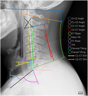 Prevalence and risk factors of occupational neck pain in Chinese male fighter pilots: a cross-sectional study based on questionnaire and cervical sagittal alignment